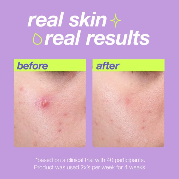 Breakout Clearing Liquid Peel 30ml