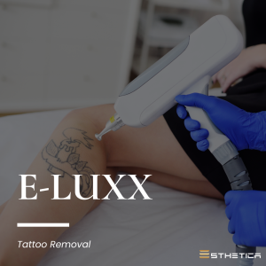 Tattoo Removal Result