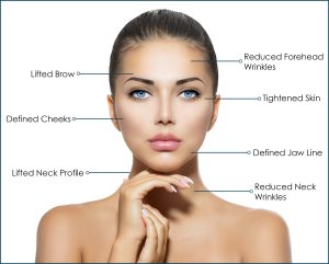 HIFU Face Map Treatment Schofields